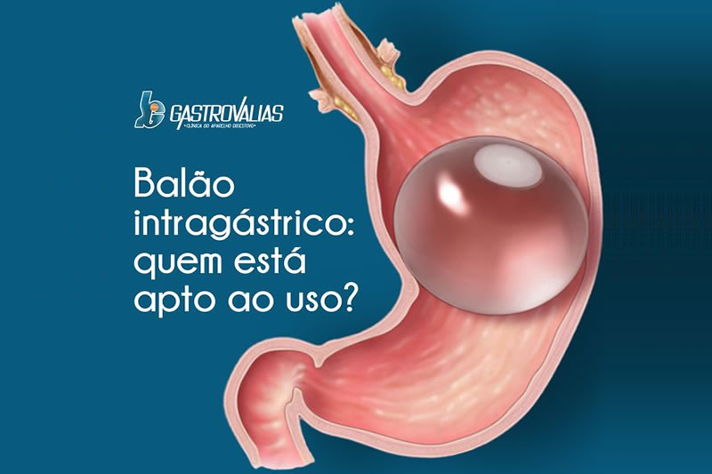 Balão Intragástrico - Quem está apto ao uso?